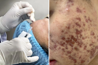Người đàn ông mặt như tổ ong sau liệu trình trị sẹo "siêu tốc" tại spa
