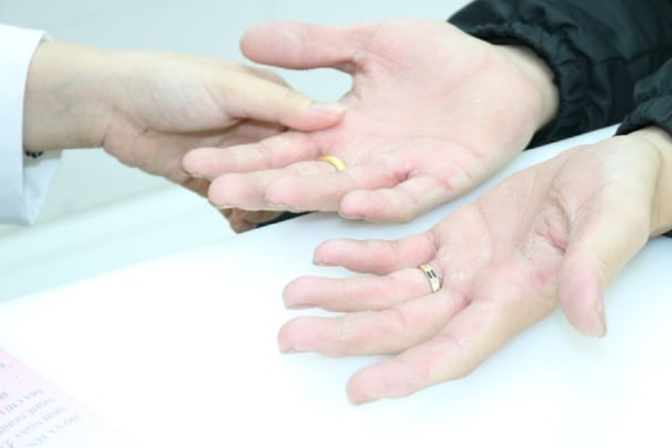 Nhiều người tổn thương da vì thường xuyên sát khuẩn phòng Covid-19 - 2 Nhiều người tổn thương da vì thường xuyên sát khuẩn phòng Covid-19 - 2