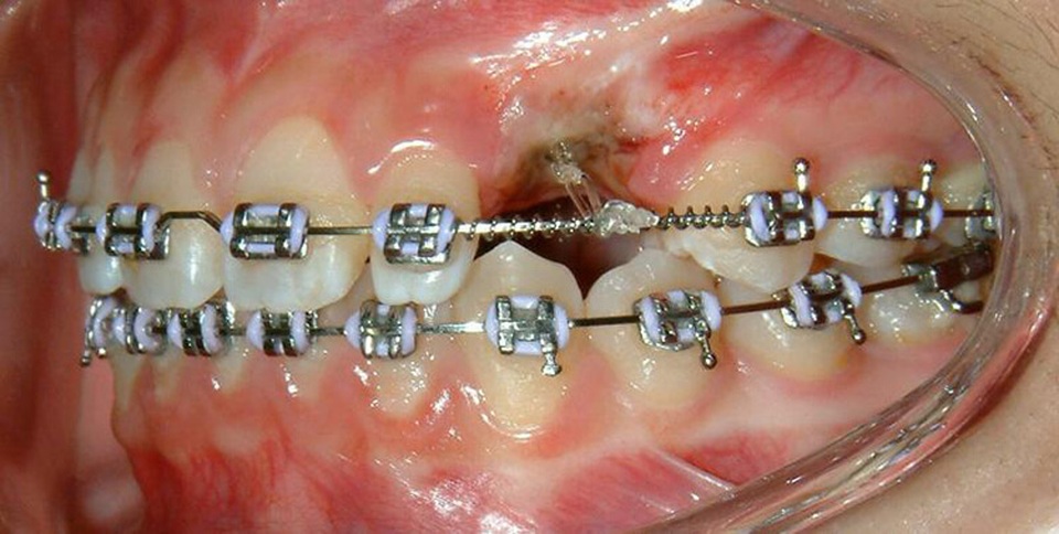 Cơn sốt Niềng răng chưa đến 10 triệu đồng? Thực hư ra sao? - 2 Cơn sốt Niềng răng chưa đến 10 triệu đồng? Thực hư ra sao? - 2