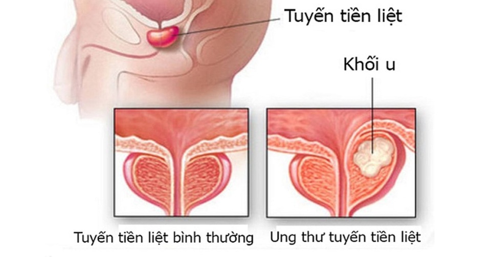 Dấu hiệu cảnh báo ung thư tiền liệt tuyến - 1 Dấu hiệu cảnh báo ung thư tiền liệt tuyến - 1