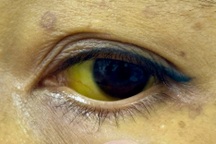 Men gan tăng 25 lần sau khi bỏ thuốc kê đơn để uống nước lá cây