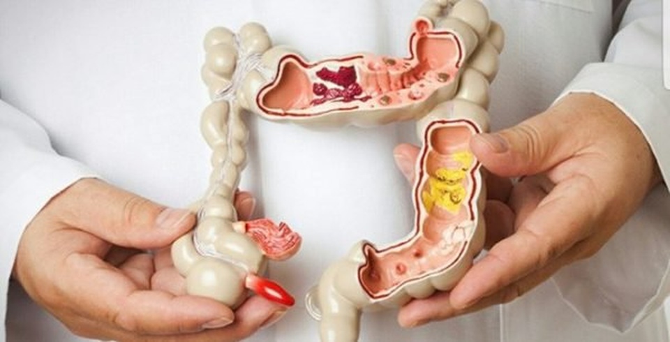 Thường xuyên ăn súp lơ xanh để bảo vệ cơ thể trước 6 loại ung thư phổ biến - 2 Thường xuyên ăn súp lơ xanh để bảo vệ cơ thể trước 6 loại ung thư phổ biến - 2