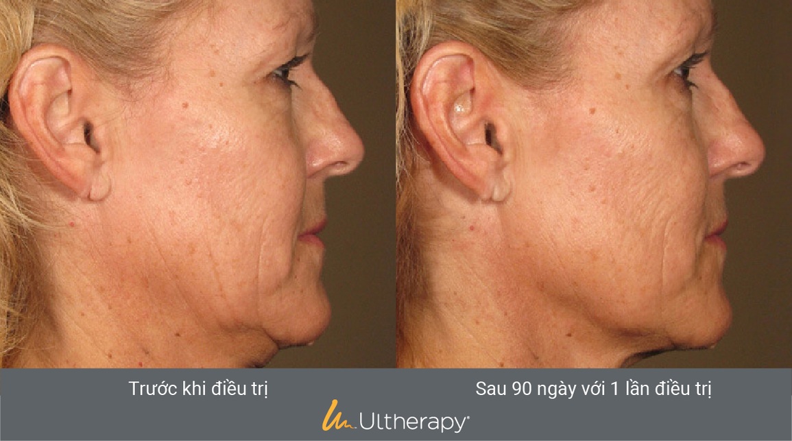 Đẩy lùi lão hóa sớm với công nghệ nâng cơ, căng da Ultherapy - 4 Đẩy lùi lão hóa sớm với công nghệ nâng cơ, căng da Ultherapy - 4