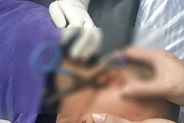 Hãi hùng cảnh bé trai 2 tuổi bị kéo đâm sâu vào tai