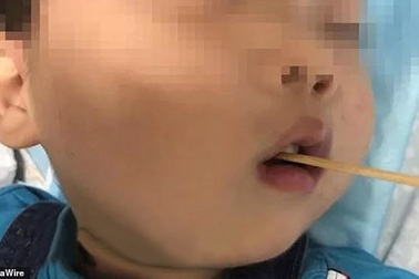 Bị que xiên xúc xích dài 10cm đâm vào não, bé trai 3 tuổi sống sót thần kỳ