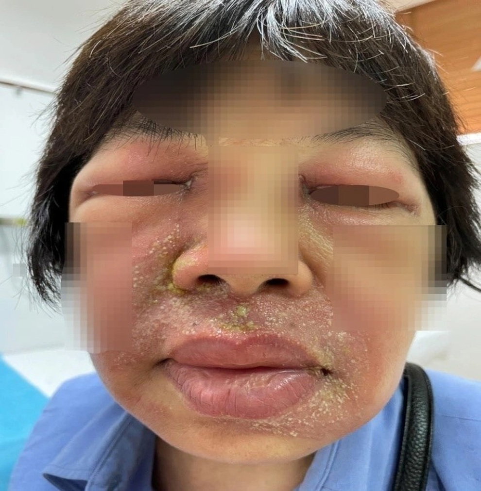Sưng húp mắt, bỏng rộp, vằn vện khắp người sau một đêm vì kiến ba khoang - 2 Sưng húp mắt, bỏng rộp, vằn vện khắp người sau một đêm vì kiến ba khoang - 2