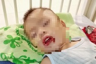 Bé trai 21 tháng tuổi loét thực quản, dạ dày vì uống nhầm chất tẩy bồn cầu