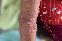 Bị sứa biển tấn công, bé gái trúng độc bỏng rộp cánh tay