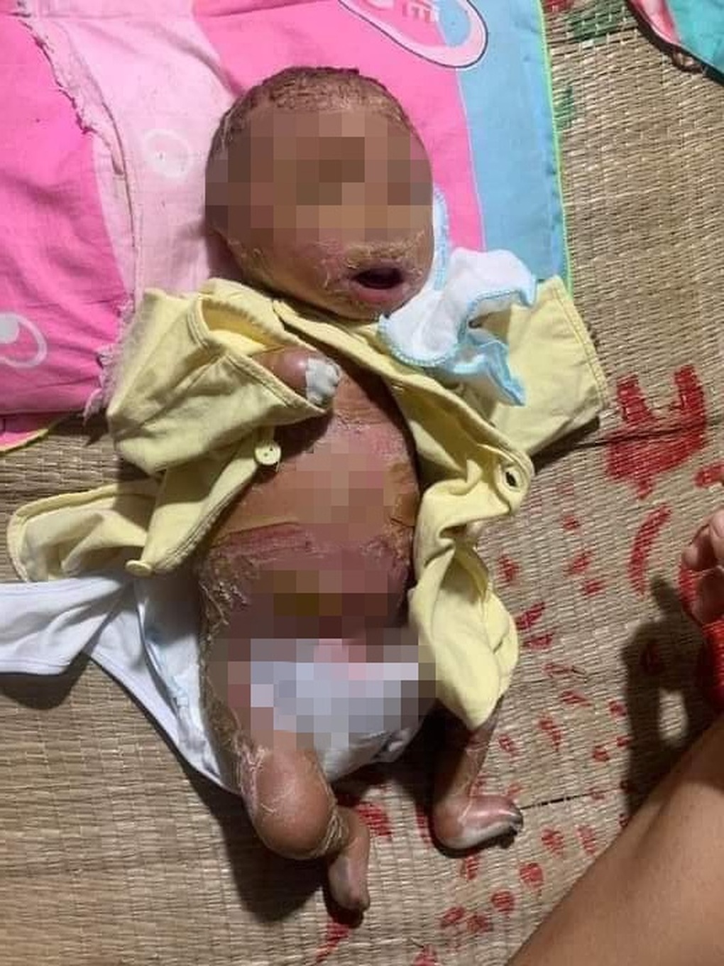 Cháu bé ở Bình Thuận mang da vảy cá toàn thân, cả thế giới chỉ có 200 ca - 1 Cháu bé ở Bình Thuận mang da vảy cá toàn thân, cả thế giới chỉ có 200 ca - 1