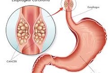 4 giai đoạn của ung thư thực quản