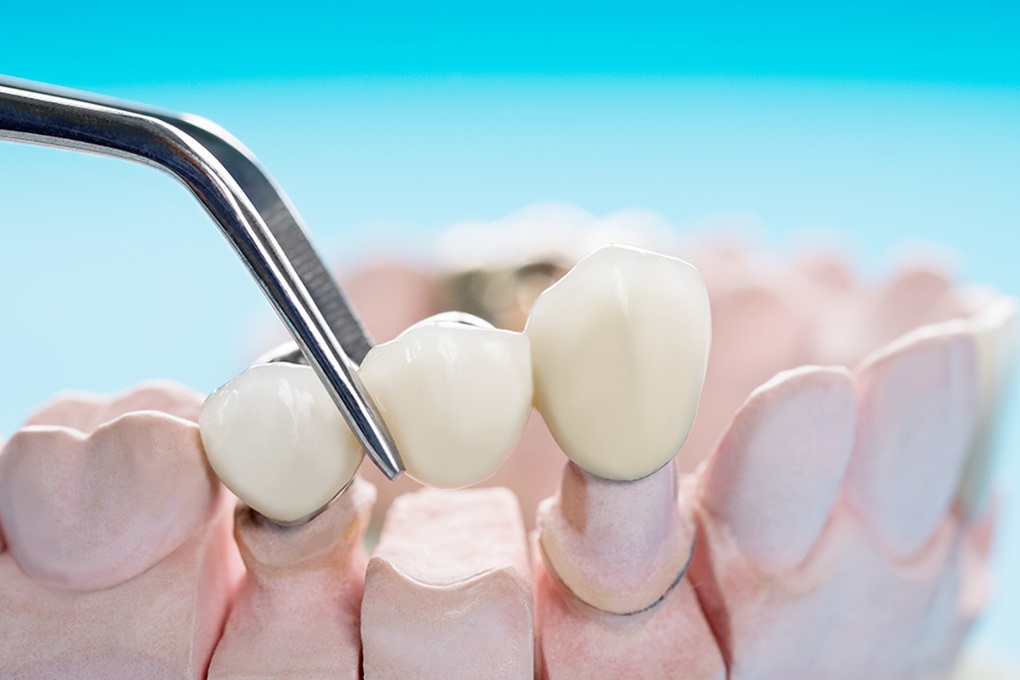 Rụng răng: Dấu hiệu của bệnh lý cần lưu ý và cách khắc phục - 5 Rụng răng: Dấu hiệu của bệnh lý cần lưu ý và cách khắc phục - 5