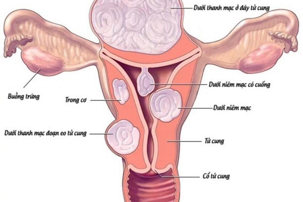 U Xơ Tử Cung Có Phải Mổ Không? Giải Pháp Điều Trị Tối Ưu Cho Sức Khỏe Phụ Nữ