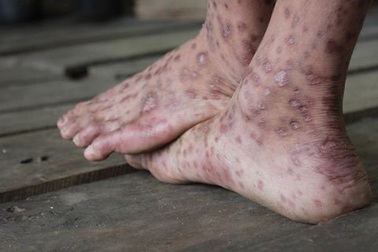 “Bệnh lạ” Quảng Ngãi không thể là bệnh “ghẻ cóc”