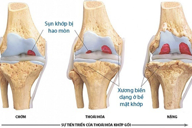 Xương khớp Ngọc Linh sản phẩm dành cho người thoái hóa khớp