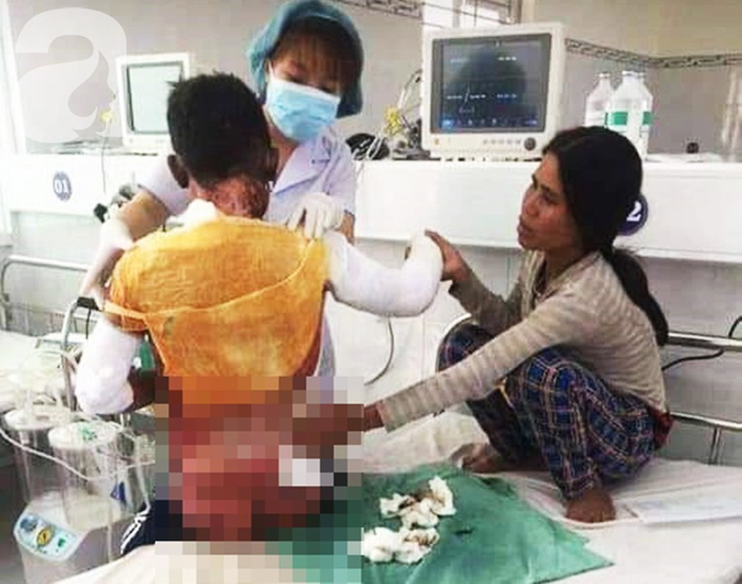 Thương tâm: Vợ chồng nghèo Gia Lai bất lực nhìn bé trai 14 tuổi nguy kịch vì bỏng xăng ngoài rẫy - Ảnh 3. Thương tâm: Vợ chồng nghèo Gia Lai bất lực nhìn bé trai 14 tuổi nguy kịch vì bỏng xăng ngoài rẫy - Ảnh 3.