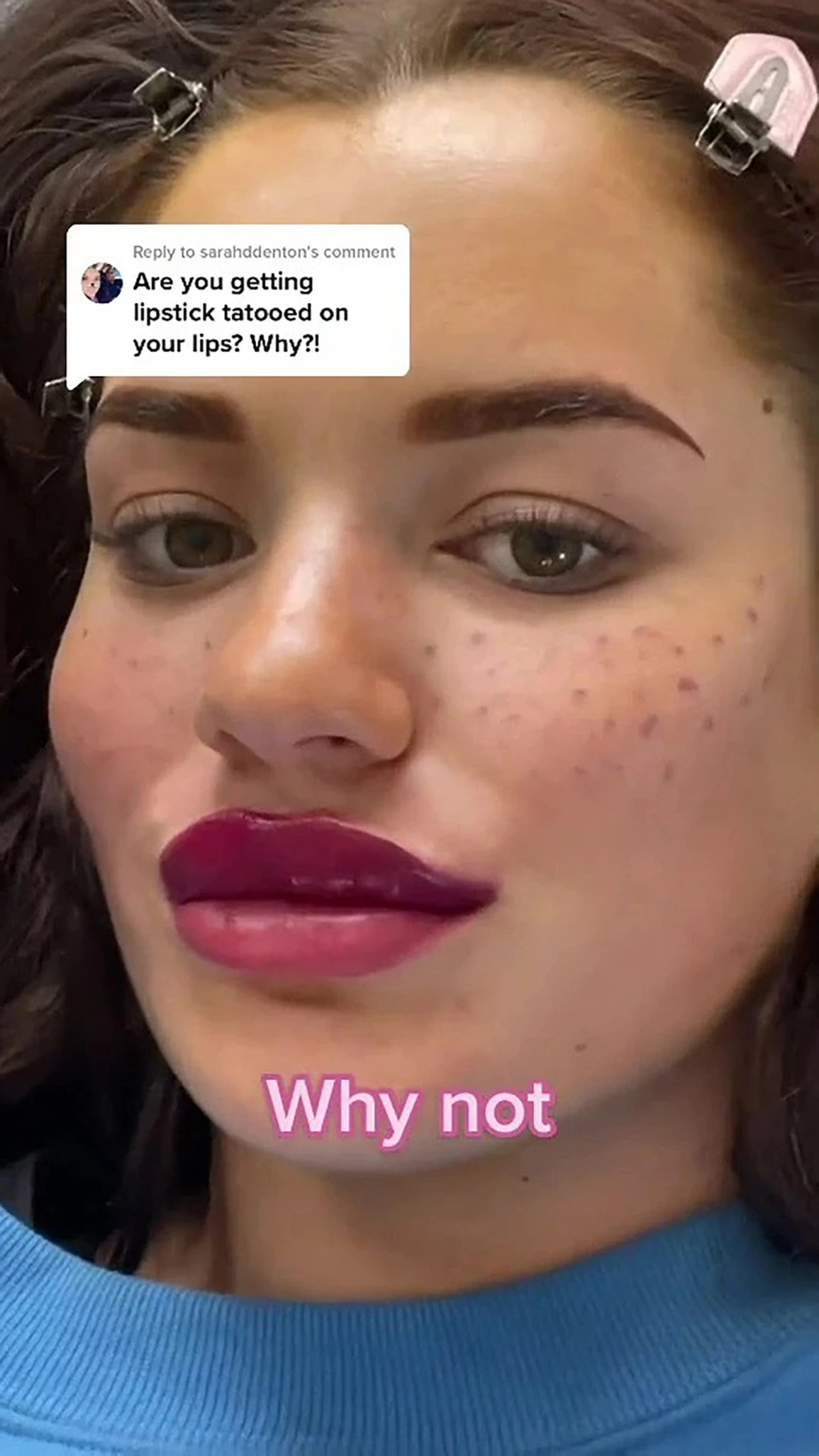 Cô gái trẻ bị mù tạm thời và sẹo vĩnh viễn trên mặt vì tự xăm tàn nhang - 3