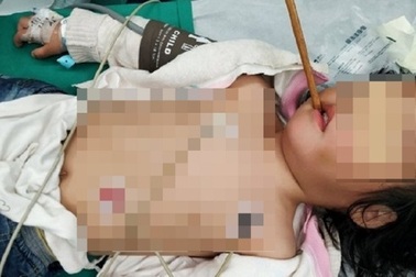 Vừa ăn vừa chạy, bé 3 tuổi bị đũa xuyên qua hộp sọ
