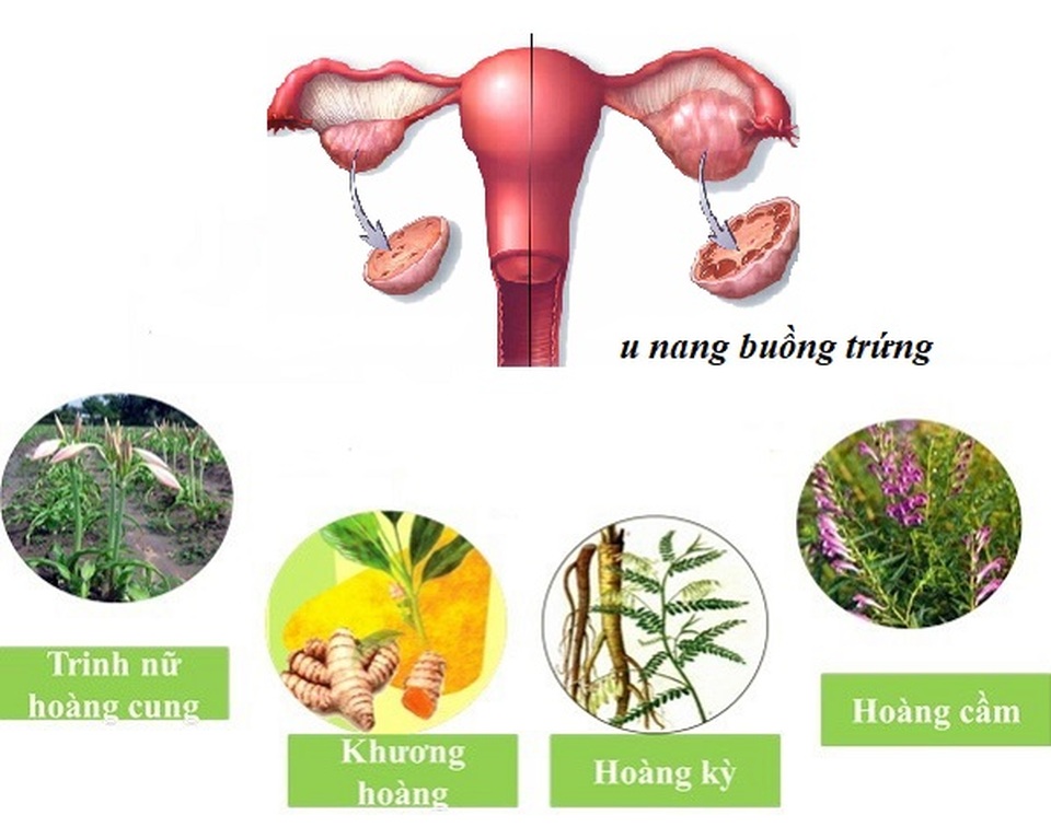Nga Phụ Khang - Giải pháp giúp cải thiện u nang buồng trứng an toàn, hiệu quả - 3 Nga Phụ Khang - Giải pháp giúp cải thiện u nang buồng trứng an toàn, hiệu quả - 3