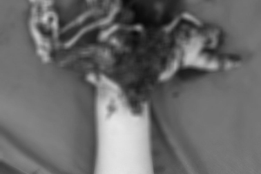 Vừa dùng vừa cắm sạc, điện thoại phát nổ làm thiếu niên 16 tuổi nát tay trái