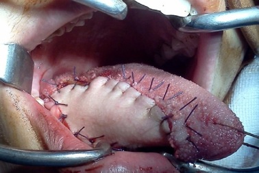 Lưỡi bị ung thư sau khi cắt được bác sĩ tái tạo như thế nào?