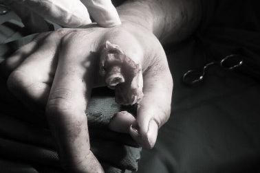 Nam thanh niên bị máy xay thịt chém lìa ngón tay