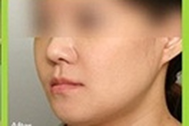 Tổng quát về móm (khớp cắn ngược, vẩu hàm) và cách điều trị