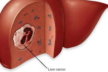 Chủ quan với biểu hiện này, người đàn ông bị ung thư di căn gan