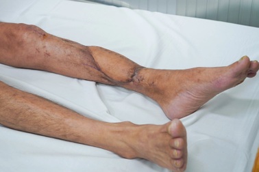Người Việt đầu tiên được ghép xương chân gãy nặng nề bằng mảnh in đặc biệt