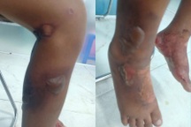 Giám định thương tật đối với bé trai bị bỏng rộp nghi do bạo hành ở TPHCM