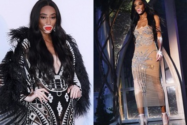 Siêu mẫu bị bạch biến khoe dáng gợi cảm