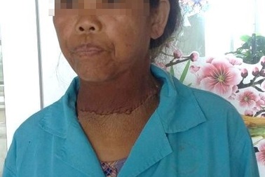 Cắt bỏ thành công bướu giáp "khủng" 2,5kg