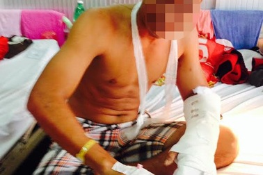 Nối bàn tay trái cho nam thanh niên bị em họ chặt rớt