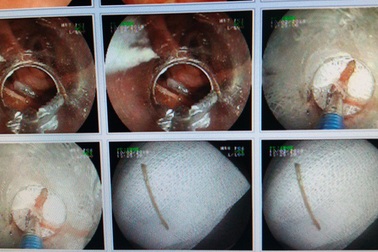 Nghẹn thở, nuốt đau vì hóc xương vịt