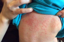 Dịch sởi nghiêm trọng nếu không lấp "khoảng trống vaccine"