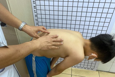 Bác sĩ chỉ cách dễ dàng phát hiện trẻ bị vẹo cột sống