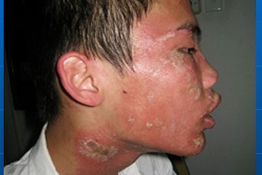 Sốt cao, sưng đau vì nọc độc kiến ba khoang