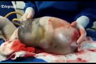 Hy hữu em bé sinh ra với túi ối bao bọc