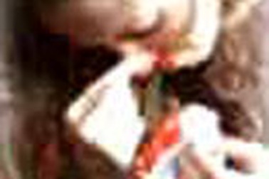 Chảy máu cam và cách xử trí 