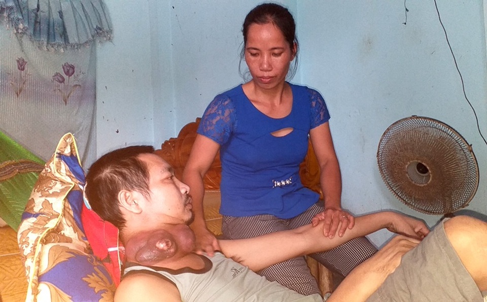 Người đàn ông nghèo đau đớn mang khối u như những chiếc bát úp vào cổ - 4 Người đàn ông nghèo đau đớn mang khối u như những chiếc bát úp vào cổ - 4