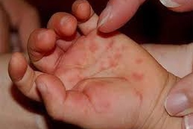 Thuốc chống virus “chữa khỏi” bệnh tay chân miệng?