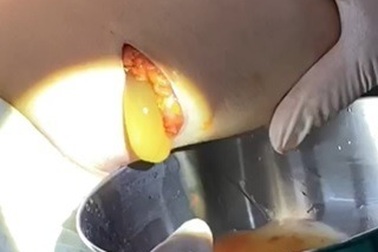 Nữ bệnh nhân bị vỡ túi ngực không triệu chứng sau 10 năm