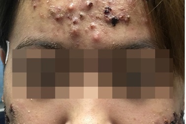 Kinh hoàng gương mặt mụn trứng cá như mảng cơm cháy của cô gái 20 tuổi