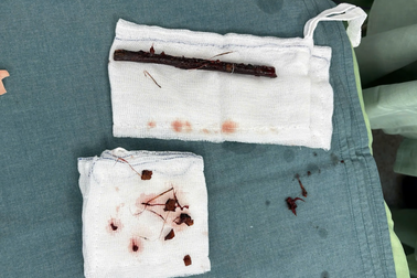 Hy hữu bé gái bị cành cây đâm xuyên hậu môn, nằm trong bụng suốt 4 tháng