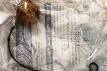 Quên ống xông 9 năm trong cơ thể, cụ bà bị sỏi niệu quản to như quả trứng