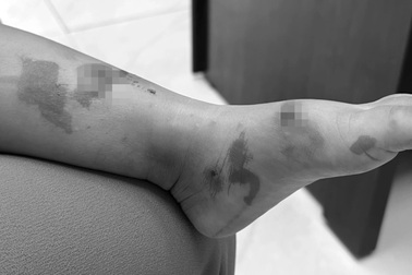 Hàng loạt cha mẹ đưa con đi viện cầu cứu vì phát bệnh chốc sau tựu trường