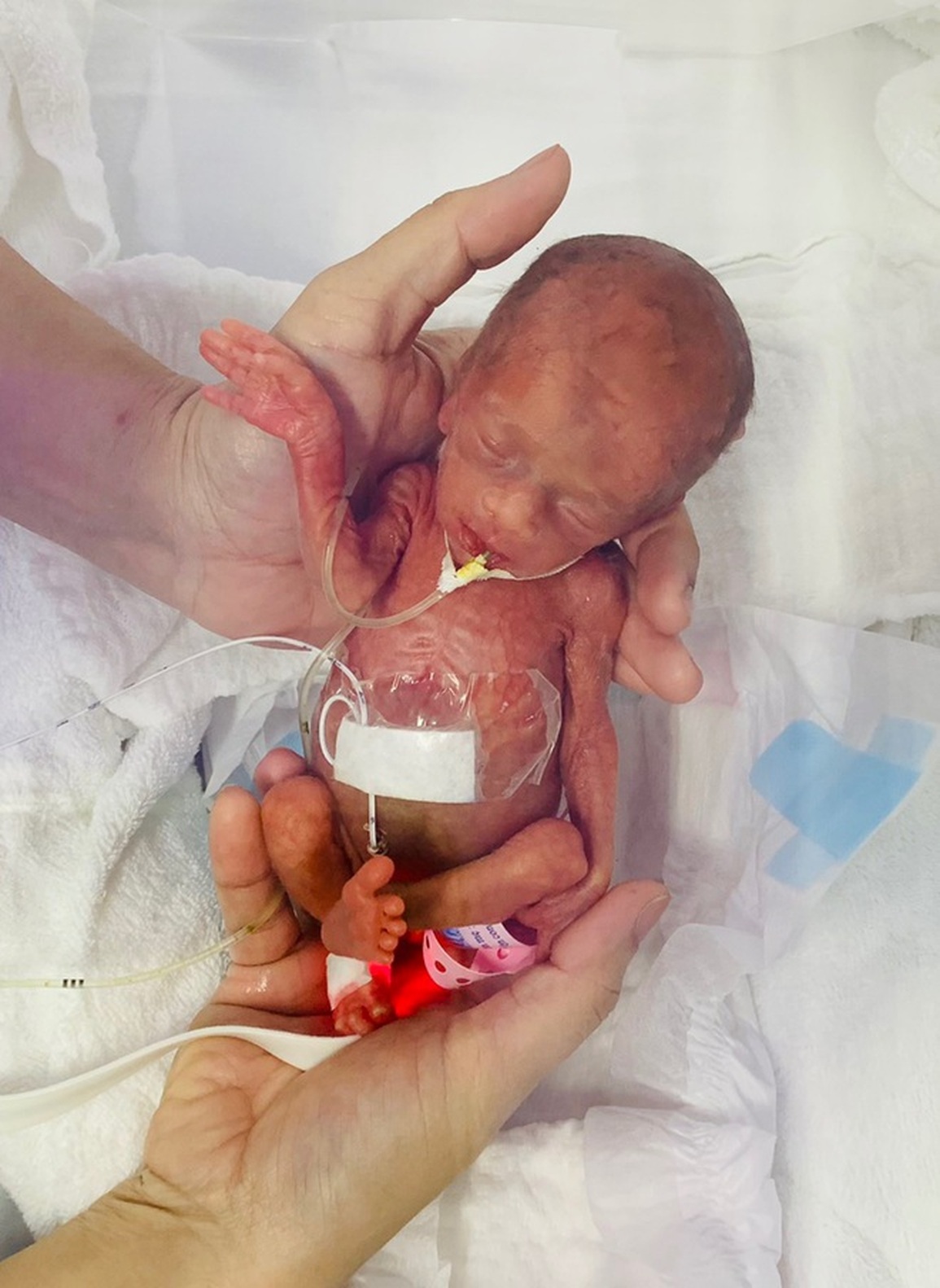 Bé sơ sinh nhỏ nhất Việt Nam đón Tết đầu tiên, từ 400gram lên gần 5kg - 2 Bé sơ sinh nhỏ nhất Việt Nam đón Tết đầu tiên, từ 400gram lên gần 5kg - 2