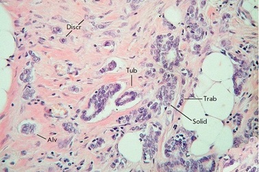 Siêu âm đưa gen trị liệu có thể giúp chống ung thư