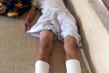 Gãy 2 chân, vỡ xương cột sống vì trèo cây bắt chim