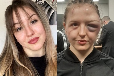 Gương mặt xinh xắn của nữ võ sĩ bị biến dạng xấu thê thảm