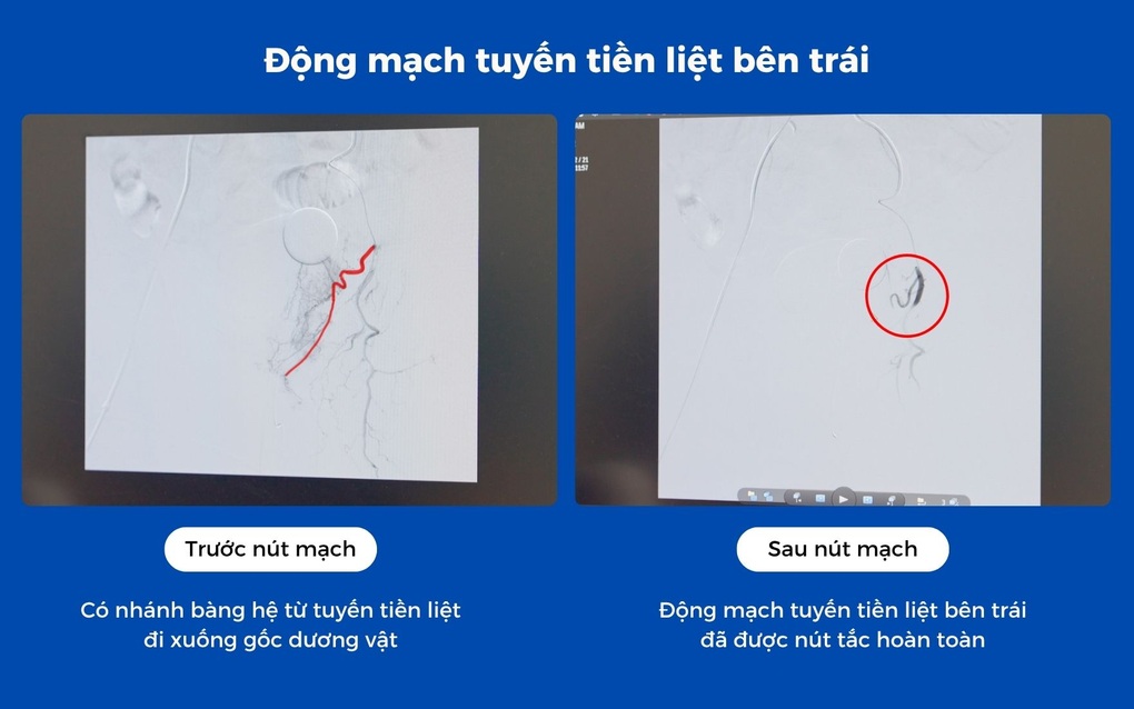 Nút mạch tuyến tiền liệt điều trị cơn đau tiểu cho bệnh nhân cao tuổi - 3 Nút mạch tuyến tiền liệt điều trị cơn đau tiểu cho bệnh nhân cao tuổi - 3